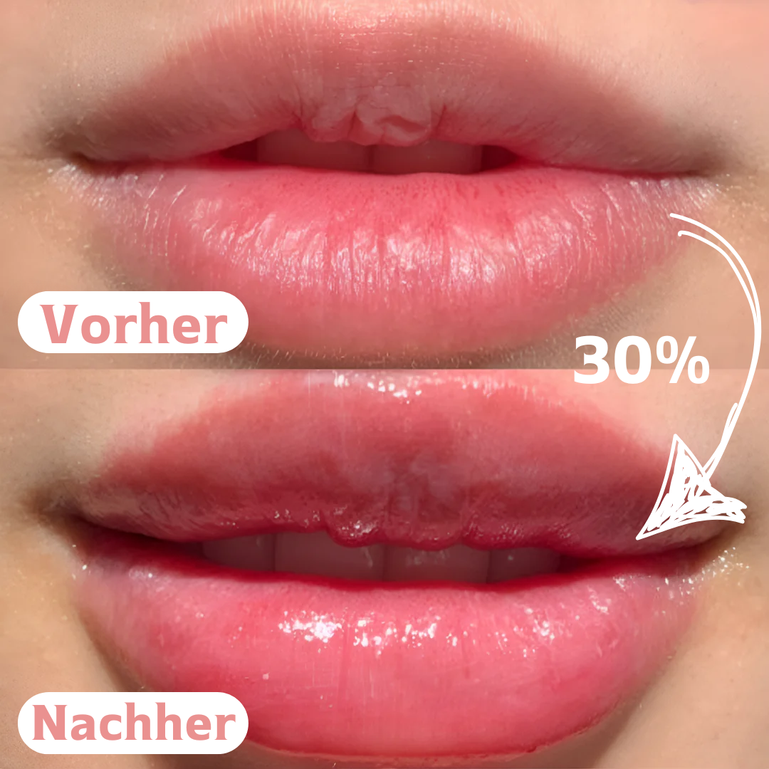 Bellaré™ LipVolume Roller Starterset